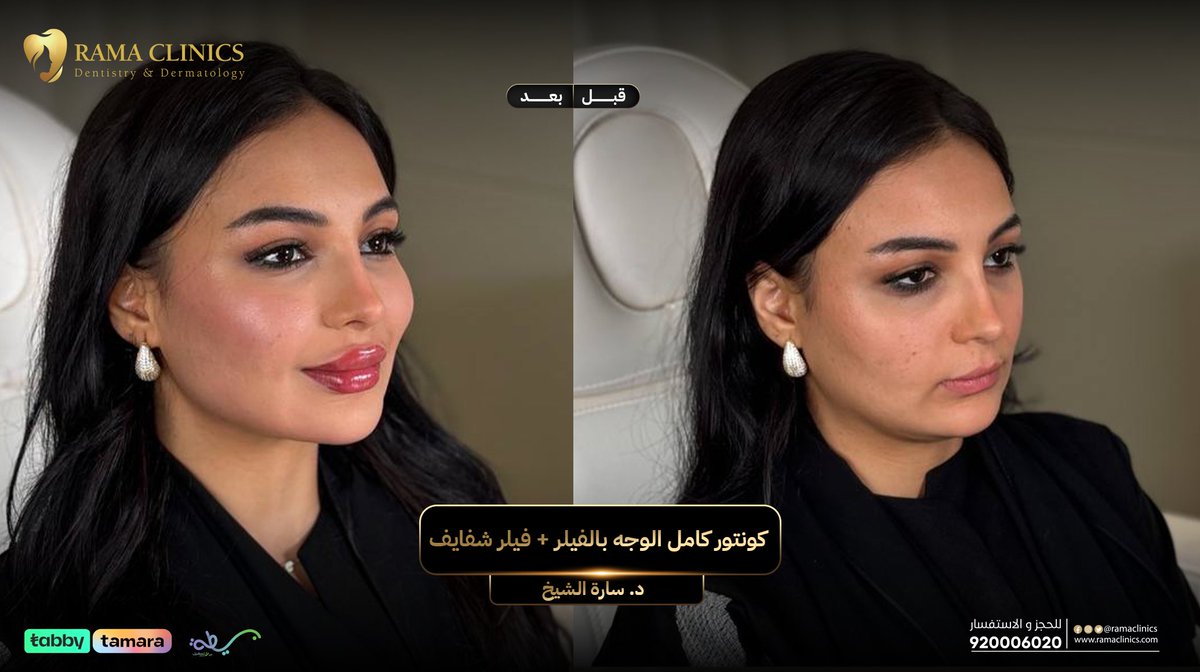 حاله كونتور كامل الوجه بالفيلر + فيلر شفايف مع دكتوره ساره الشيخ 
الحين راح تستفيدي بكاش باك 10% راجعين لك لما تشتري عروضنا من تطبيق راما أونلاين🌟

#كاش_باك #كونتور #تجميل #عيادات_تجميل #فيلر #فيلر_الوجه #تكساس #تحديد_فك #عالمك_الخاص #rama_clinics #عروض #rama_clinics