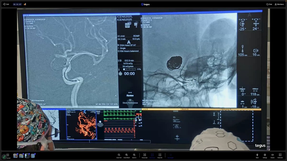 Vladimir Kalousek (@vladimirkzagreb) on Twitter photo Future is now, live streaming of aneurysm treatment to a remote conference via <a href="/TegusMedical/">Tegus Medical GmbH</a> system. Coil occlusion of aneurysm and placement of <a href="/Acandisgmbh/">Acandis</a> flow diverter on the neck. <a href="/DoctorGaldamez/">Mario Martínez-Galdámez</a> <a href="/_AdnanSiddiqui/">Adnan H. Siddiqui, MD</a> <a href="/Fie0815/">Jens Fiehler</a> <a href="/Branketara/">Branimir Čulo</a> Future is now, live streaming of aneurysm treatment to a remote conference via <a href="/TegusMedical/">Tegus Medical GmbH</a> system. Coil occlusion of aneurysm and placement of <a href="/Acandisgmbh/">Acandis</a> flow diverter on the neck. <a href="/DoctorGaldamez/">Mario Martínez-Galdámez</a> <a href="/_AdnanSiddiqui/">Adnan H. Siddiqui, MD</a> <a href="/Fie0815/">Jens Fiehler</a> <a href="/Branketara/">Branimir Čulo</a>
