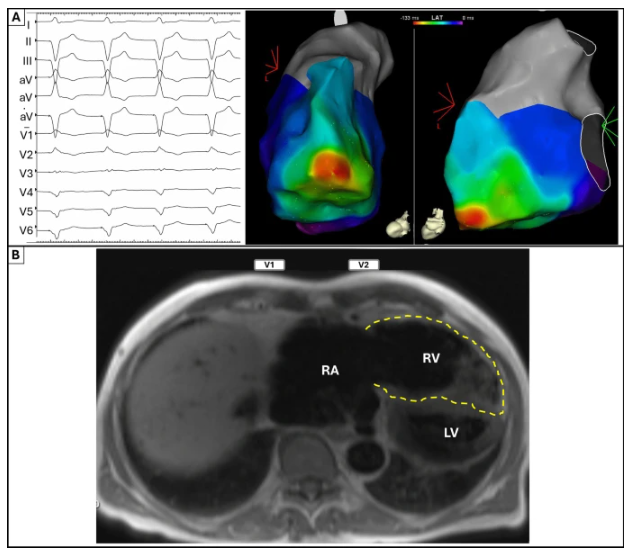 JICE (@jice_ep) on Twitter photo 🚨Images in EP #FreeRead in <a href="/JICE_EP/">JICE</a>
RBBB Pattern with RV Pacing in Arrhythmogenic Right Ventricular Cardiomyopathy
🧐📖rdcu.be/embdg
by <a href="/adrian_petzl/">Adrian Petzl</a>, <a href="/MichaelGurinMD/">Michael Gurin</a> & Francis E. Marchlinski
#EPeeps 🚨Images in EP #FreeRead in <a href="/JICE_EP/">JICE</a>
RBBB Pattern with RV Pacing in Arrhythmogenic Right Ventricular Cardiomyopathy
🧐📖rdcu.be/embdg
by <a href="/adrian_petzl/">Adrian Petzl</a>, <a href="/MichaelGurinMD/">Michael Gurin</a> & Francis E. Marchlinski
#EPeeps