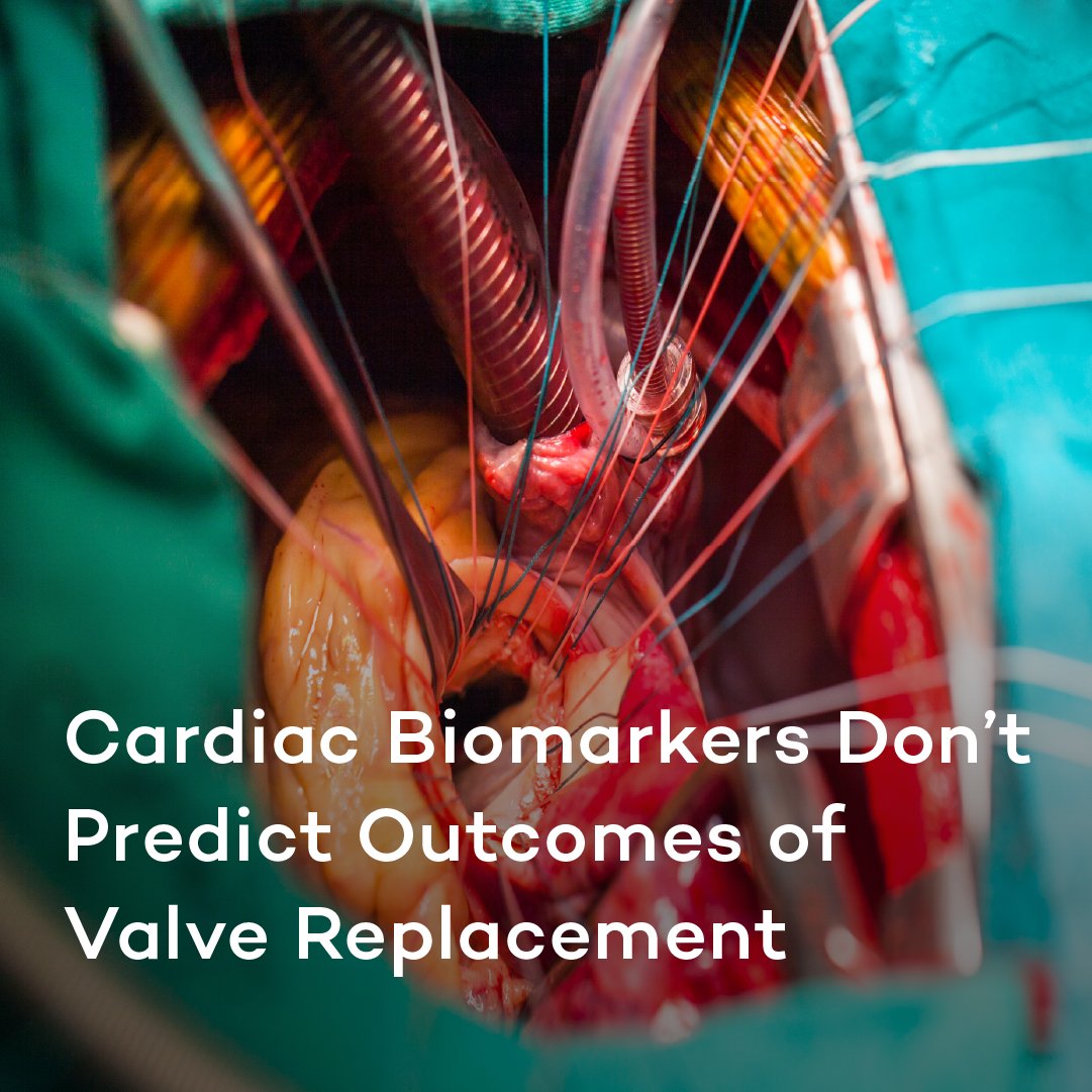 NU Internal Medicine (@nu_intmed) on Twitter photo Measuring standard cardiac biomarkers did not predict whether patients with asymptomatic severe aortic stenosis would benefit from nonsurgical aortic valve replacement, according to a recent study published in Circulation. <a href="/NMCardioVasc/">NM Cardiovascular</a>
(Article linked below!) Measuring standard cardiac biomarkers did not predict whether patients with asymptomatic severe aortic stenosis would benefit from nonsurgical aortic valve replacement, according to a recent study published in Circulation. <a href="/NMCardioVasc/">NM Cardiovascular</a>
(Article linked below!)