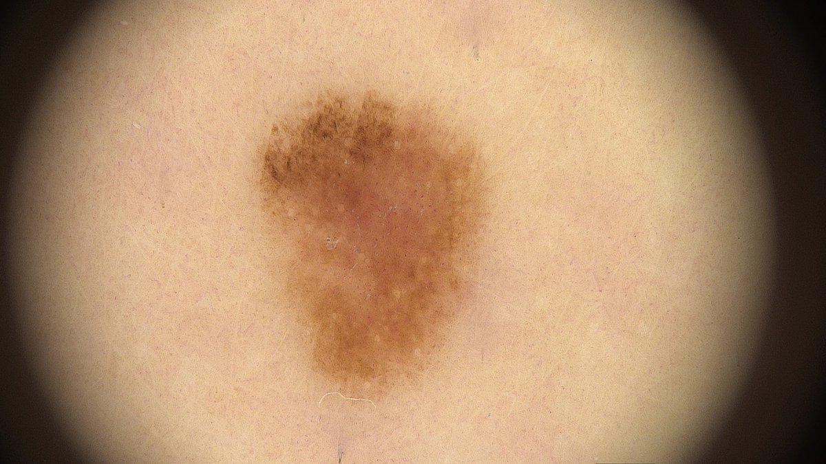 Früh erkannt – Leben gerettet! 🩺
Dr. Tamara Kopp von JUVENIS entdeckte bei einer Routinekontrolle ein Melanom am Bein eines Patienten – im Frühstadium.
📸 Fotos &amp; Makroaufnahme zeigen, wie tückisch Hautkrebs aussehen kann.  👉juvenismed.at/fruehzeitige-e…