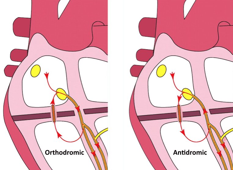 TrackYourHeart's tweet photo. Antidromic reciprocating tachycardia in a patient with Wolff-Parkinson-White refers to:
A) AV conduction proceeding via the normal AV conduction system with return via the accessory pathway
B) AV conduction via the accessory pathway with return via the normal ventriculoatrial conduction system
C) AVNRT with additional conduction via the accessory pathway
D) None of the above

Comment your answer 👇

#Cardiology #WPW #EP #MedEd