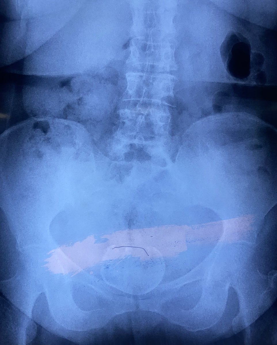 drrobinbasnet's tweet photo. Pandora’s box … Urinary symptoms, USG suggestive and KUB diagnostic of bladder stone turned out to be Calcified Uterine Fibroid !!! https://t.co/z5uydiO4oS