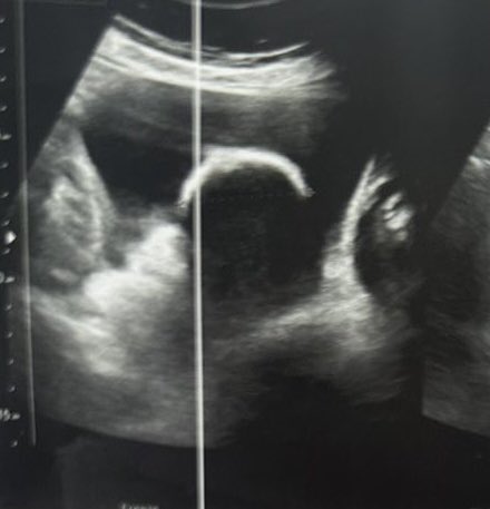 drrobinbasnet's tweet photo. Pandora’s box … Urinary symptoms, USG suggestive and KUB diagnostic of bladder stone turned out to be Calcified Uterine Fibroid !!! https://t.co/z5uydiO4oS