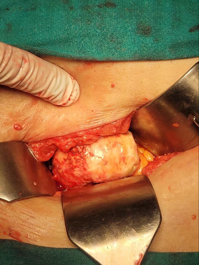 drrobinbasnet's tweet photo. Pandora’s box … Urinary symptoms, USG suggestive and KUB diagnostic of bladder stone turned out to be Calcified Uterine Fibroid !!! https://t.co/z5uydiO4oS