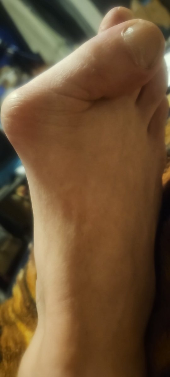 N3v3rpanic's tweet photo. They are getting bad to where it starting to hurt just to walk https://t.co/QW0dHa3OCK