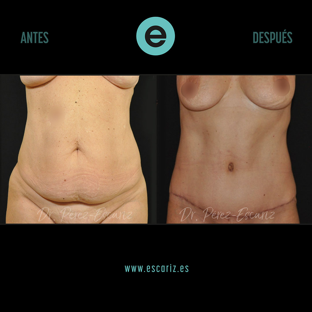 DrPerezEscariz's tweet photo. Esta paciente, tras perder peso con manga gástrica hace 8 años, presentaba exceso de piel abdominal.
✨ Con una abdominoplastia redefinimos su abdomen.
Tras 2 meses, los resultados son visibles y naturales.
📩 Contáctanos si buscas un cambio.
#abdominoplastia #DrEscariz https://t.co/woWsjqBiKc