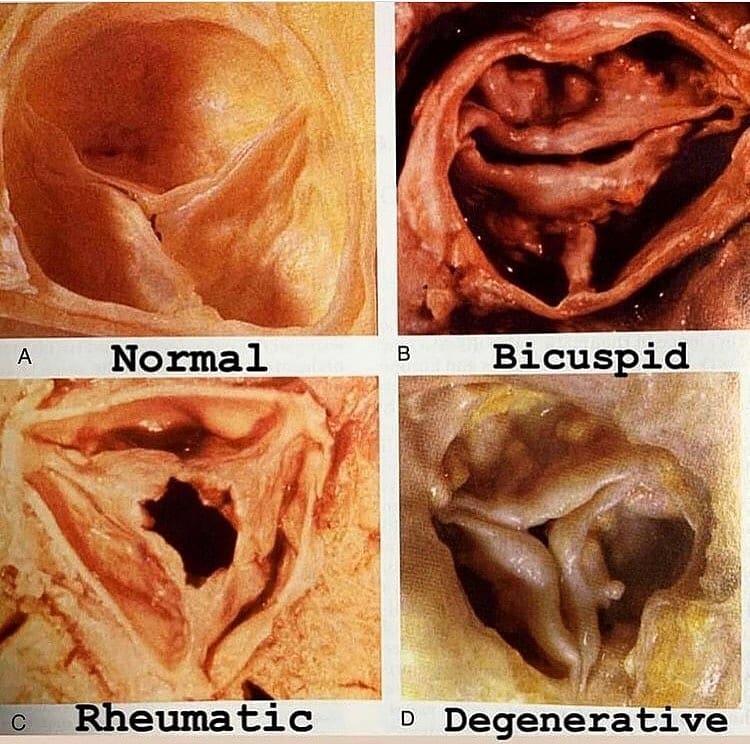 UpdatedNew0's tweet image. Various pathologies of aortic valve stenosis.A- The normal valve has three leaflets, that are thin, pliable and open wide in systole and close tight during diastole. Use this to compare to the others.B- The bicuspid valve is when someone is born with a va