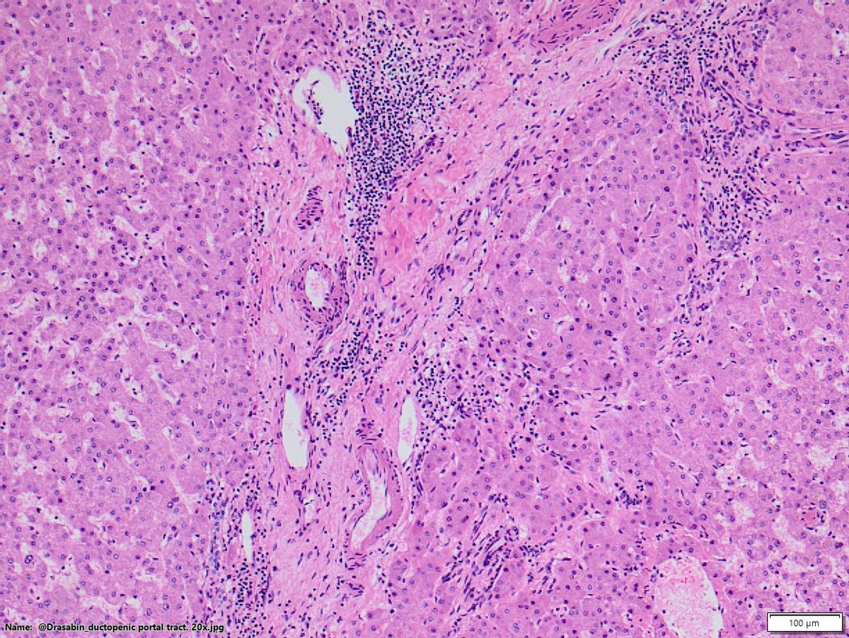 DraSabin's tweet image. Ductopenic patient. Chronic cholestasis. See copper granules both with orcein vs rodanine. Which onedo you prefer? Do you ask both? . #liverpath #cholangitis #cholestasis #pathology