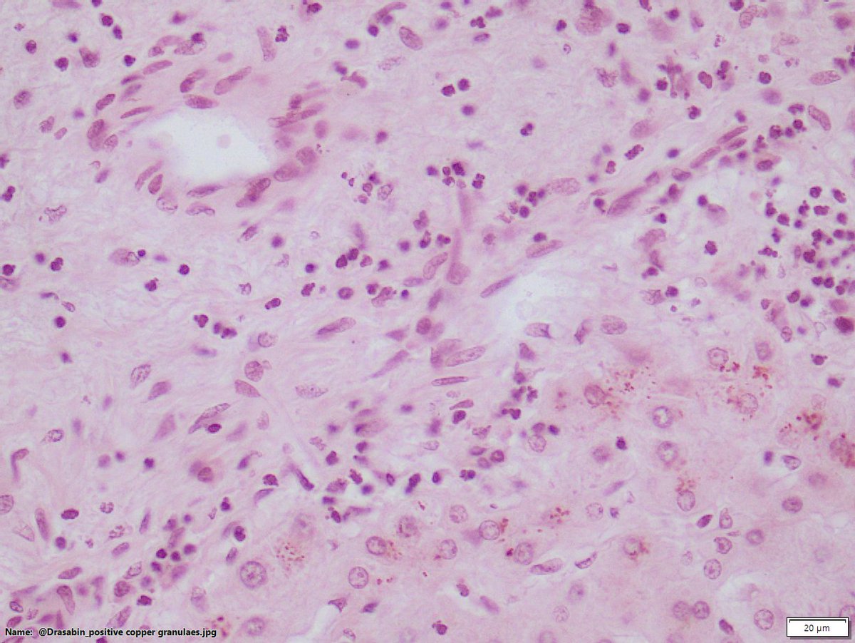 DraSabin's tweet image. Ductopenic patient. Chronic cholestasis. See copper granules both with orcein vs rodanine. Which onedo you prefer? Do you ask both? . #liverpath #cholangitis #cholestasis #pathology