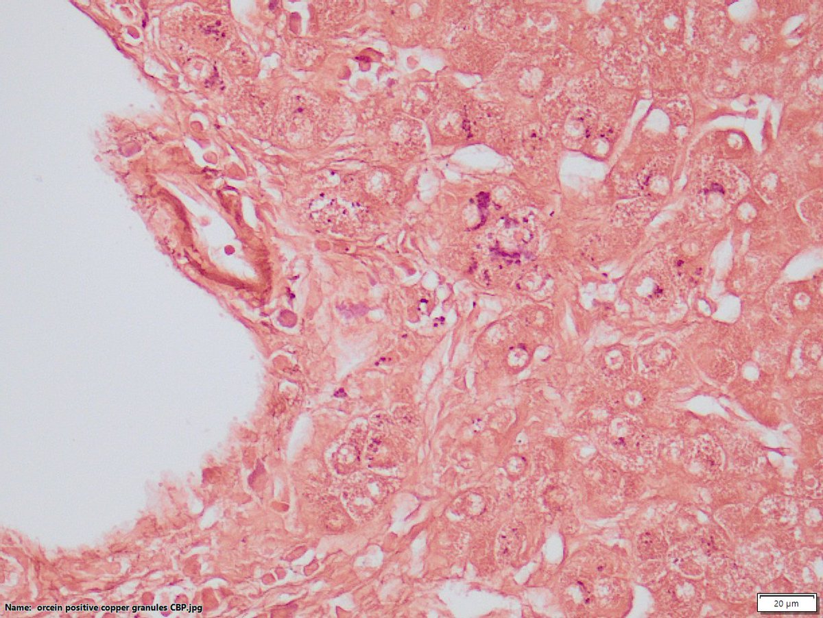 DraSabin's tweet image. Ductopenic patient. Chronic cholestasis. See copper granules both with orcein vs rodanine. Which onedo you prefer? Do you ask both? . #liverpath #cholangitis #cholestasis #pathology