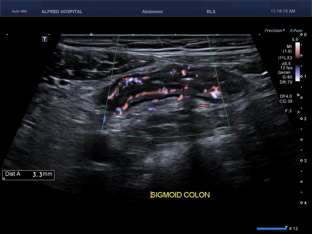 24 M new Dx UC presenting with ASUC. Responds to IV steroids in hospital and starts 5-ASA, AZA (now therapeutic) and pred taper post discharge. IUS is performed 8 weeks post discharge. Without knowing symptoms, based on IUS findings, what would be next best step in management?