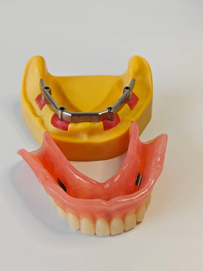 SZDiamonddental's tweet image. #implant #allon4 #fixedteeth #dentallab #DentalCare #