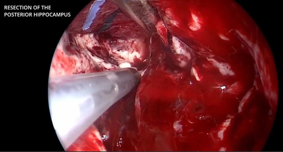 TheJNS's tweet photo. #OperativeVideo Endoscopic transorbital amygdalohippocampectomy for the resection of an epileptogenic lesion
https://t.co/aRZCIB1CuX https://t.co/N7Fsw6Bd9r