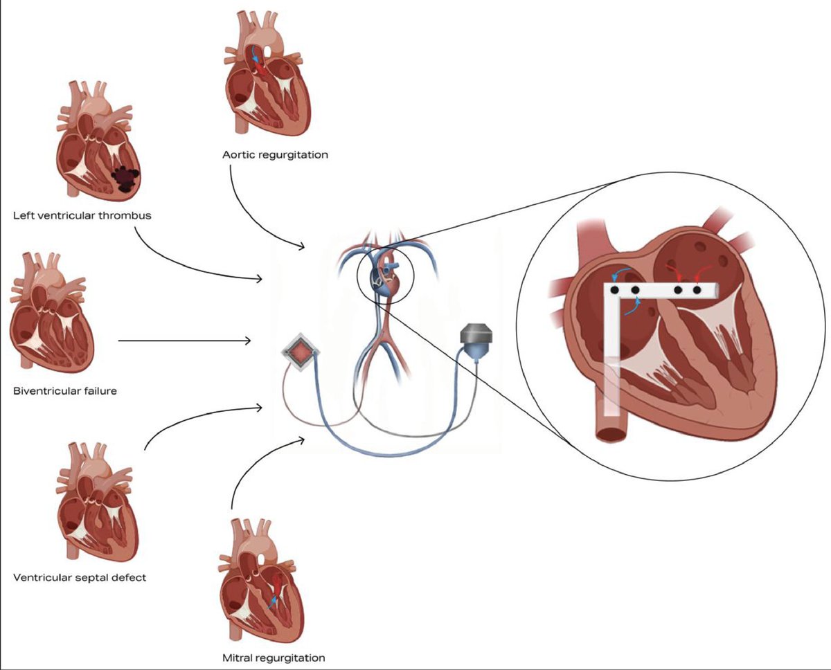 Sant Kumar (@sant_j_kumar) on Twitter photo 1/7 📢 Our new review dives deep into Left Atrial Veno-Arterial ECMO for cardiogenic shock in severe valvular heart disease. Traditional therapies often worsen LV overload 💔—LAVA-ECMO provides promising relief! #cardiotwitter <a href="/JCVAonline/">Journal of Cardiothoracic and Vascular Anesthesia</a>
<a href="/AhmadJabri8/">Ahmad Jabri MD , FACC, FSCAI</a> <a href="/PedroMDMSc/">Pedro Villablanca MD, MSc, FACC, FSCAI</a> 1/7 📢 Our new review dives deep into Left Atrial Veno-Arterial ECMO for cardiogenic shock in severe valvular heart disease. Traditional therapies often worsen LV overload 💔—LAVA-ECMO provides promising relief! #cardiotwitter <a href="/JCVAonline/">Journal of Cardiothoracic and Vascular Anesthesia</a>
<a href="/AhmadJabri8/">Ahmad Jabri MD , FACC, FSCAI</a> <a href="/PedroMDMSc/">Pedro Villablanca MD, MSc, FACC, FSCAI</a>