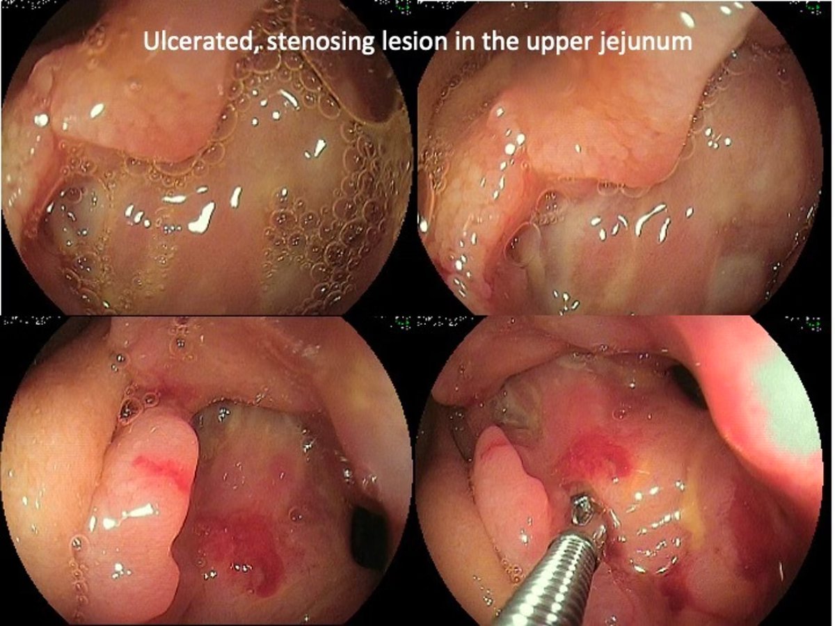 New Quiz

Small Bowel Ulcerative Diseases

What is your diagnosis?