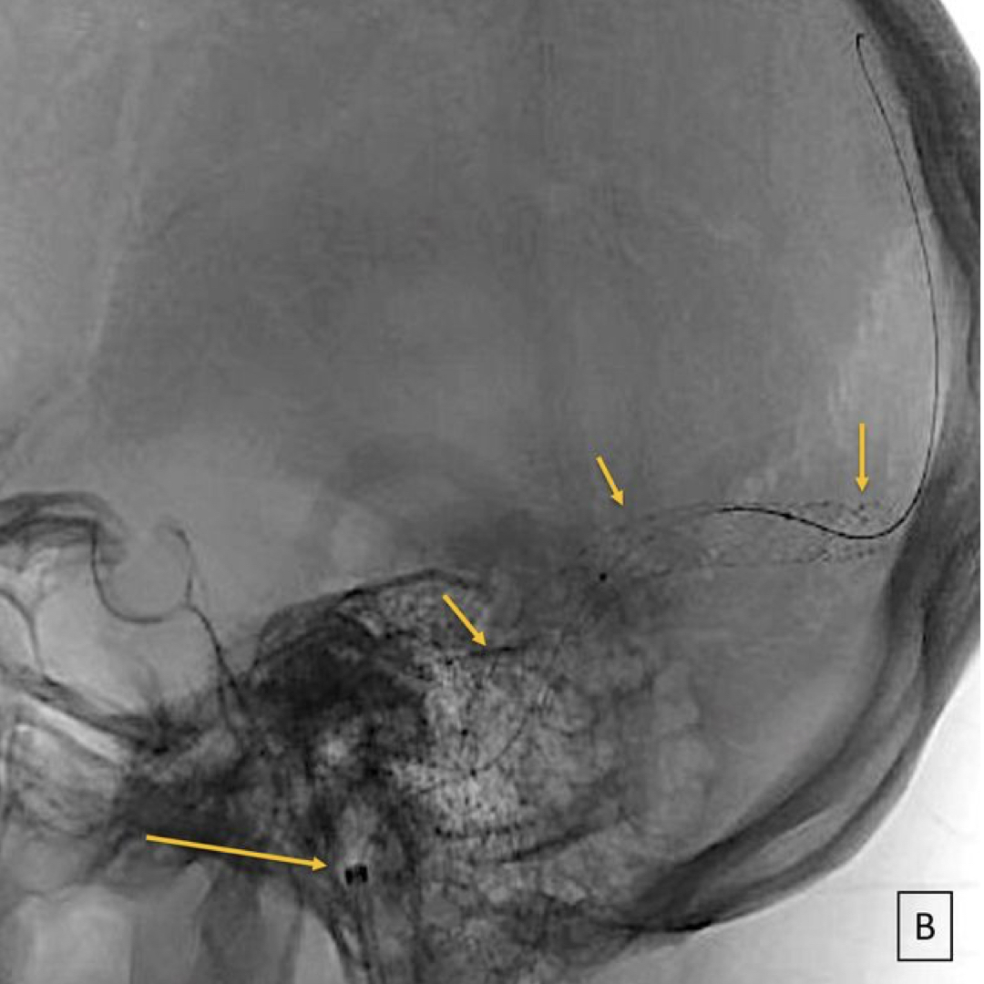 🚨 Expert Insight Alert! 🚨

The River Stent Trial confirms venous sinus stenosis stenting (VSSS) as a safe and effective treatment for idiopathic intracranial hypertension (IIH). Discover how clinical practices have evolved to prioritize noninvasive methods for post-treatment