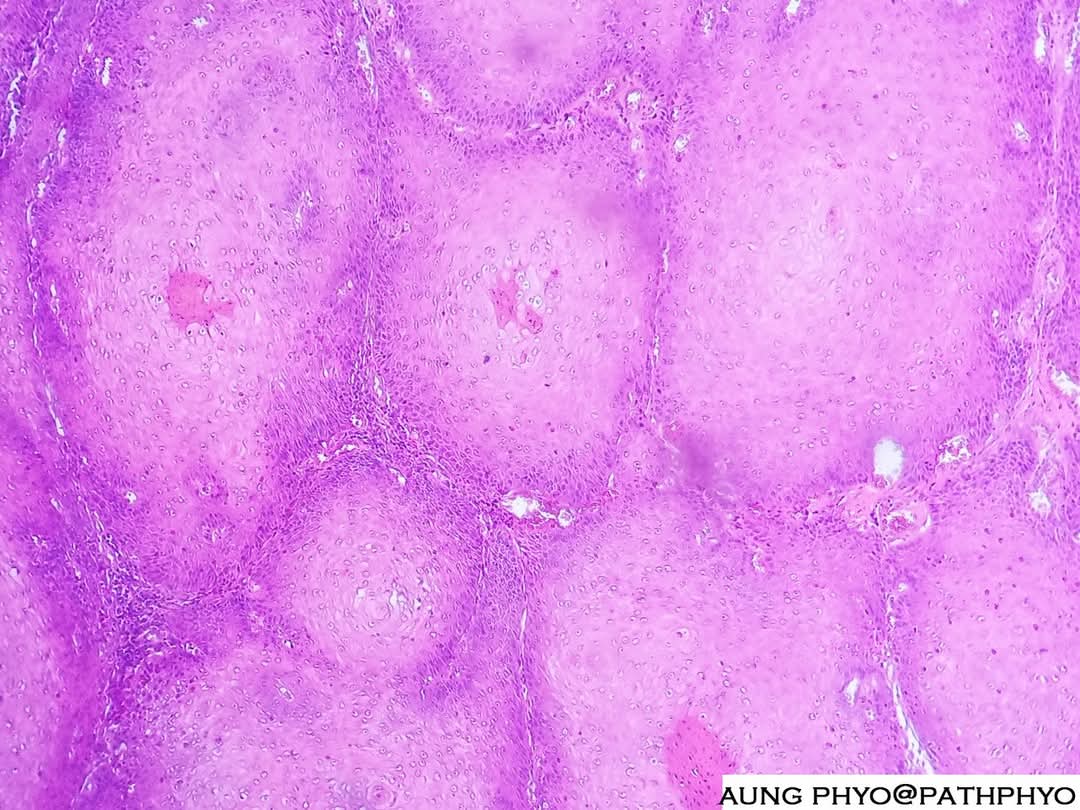 Beautiful tangential cut appearance of verucous carcinoma featuring rounded retes pegs. #pathology #dermpath #verrucous_carcinoma