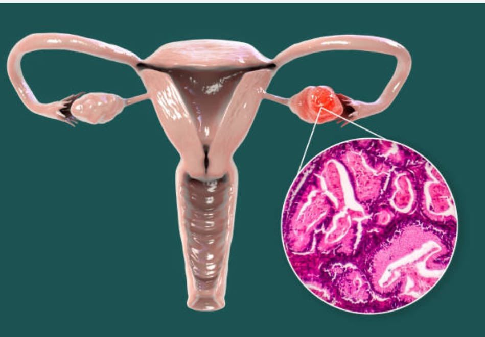 En el Día Mundial de la Lucha contra el Cáncer de Ovario 🎗️ destacamos al Servicio de Ginecología del Hospital Central del IPS, único en Paraguay con gineco-oncólogos, ofreciendo diagnóstico, cirugía y seguimiento integral. 💜 
🔗 acortar.link/Zvoh4u