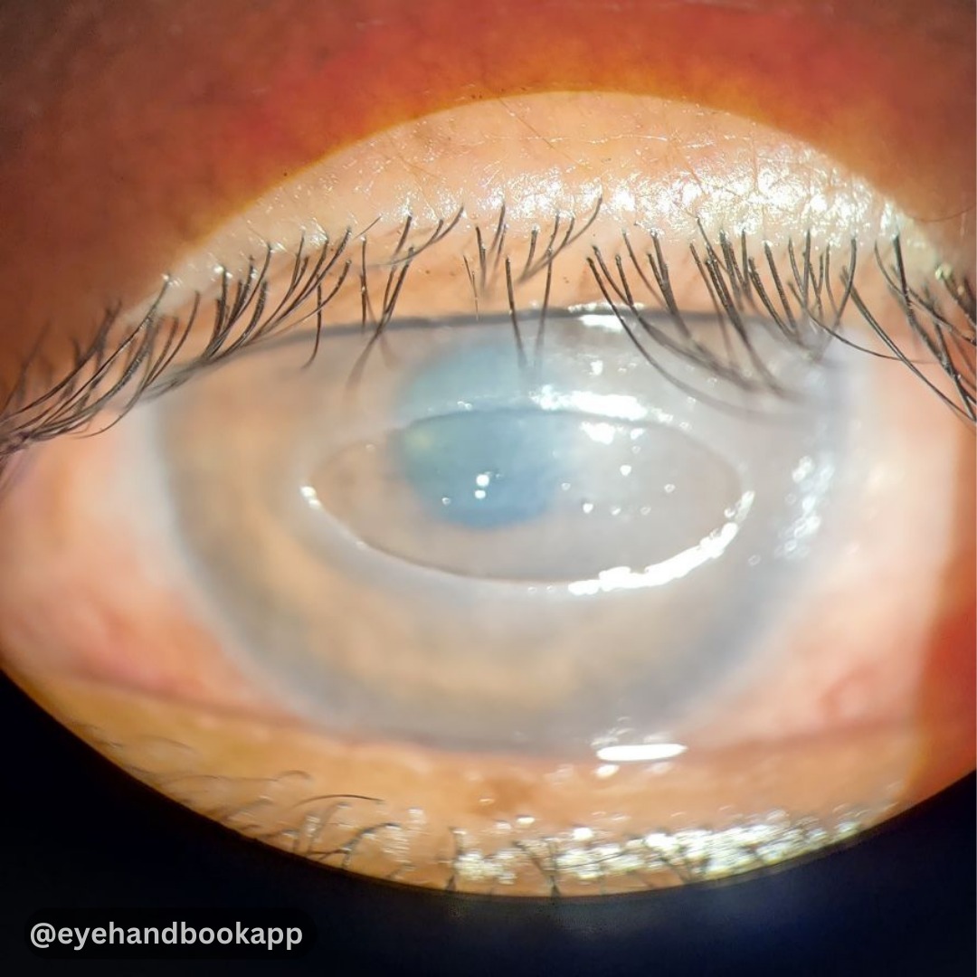 EyeHandbook's tweet photo. Neurotrophic keratopathy - Saw this stage 2 neurotrophic ulcer with rolled margins and clear underlying stroma today!
#eyes #ophthalmology #optometry #retina #cornea #ophthalmologyresidents #optometrystudent #eyesurgery #oftalmologia #ophthalmologists #optometrists #eyedoctor https://t.co/atlNcR2y4u
