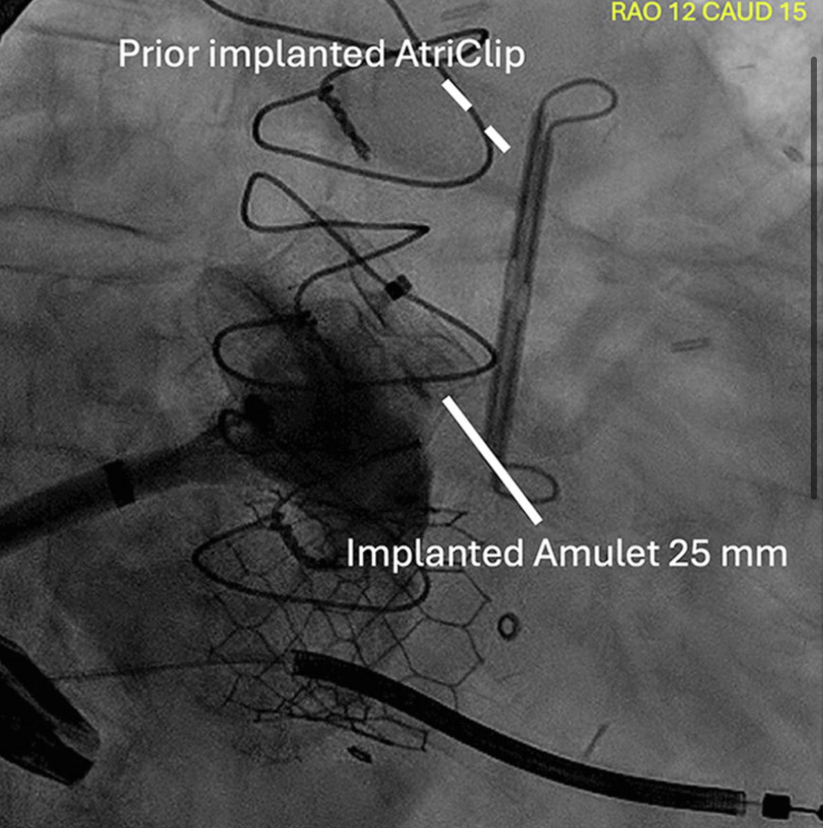 Georgi Fram, MD (@gkfram) on Twitter photo Just published, utilization of Amulet device for prior failed left atrial appendage occlusion in <a href="/JACCJournals/">JACC Journals</a>
Full article:
authors.elsevier.com/a/1l3Ie6uPJvyJ…
<a href="/TiberioFrisoli/">Tiberio Frisoli</a> <a href="/jameschilee/">James Lee</a> <a href="/LaiLeoDr/">Lai Leo</a> <a href="/PedroMDMSc/">Pedro Villablanca MD, MSc, FACC, FSCAI</a> <a href="/engelpedro/">Pedro Engel, MD, FACC, FSCAI</a> Just published, utilization of Amulet device for prior failed left atrial appendage occlusion in <a href="/JACCJournals/">JACC Journals</a>
Full article:
authors.elsevier.com/a/1l3Ie6uPJvyJ…
<a href="/TiberioFrisoli/">Tiberio Frisoli</a> <a href="/jameschilee/">James Lee</a> <a href="/LaiLeoDr/">Lai Leo</a> <a href="/PedroMDMSc/">Pedro Villablanca MD, MSc, FACC, FSCAI</a> <a href="/engelpedro/">Pedro Engel, MD, FACC, FSCAI</a>