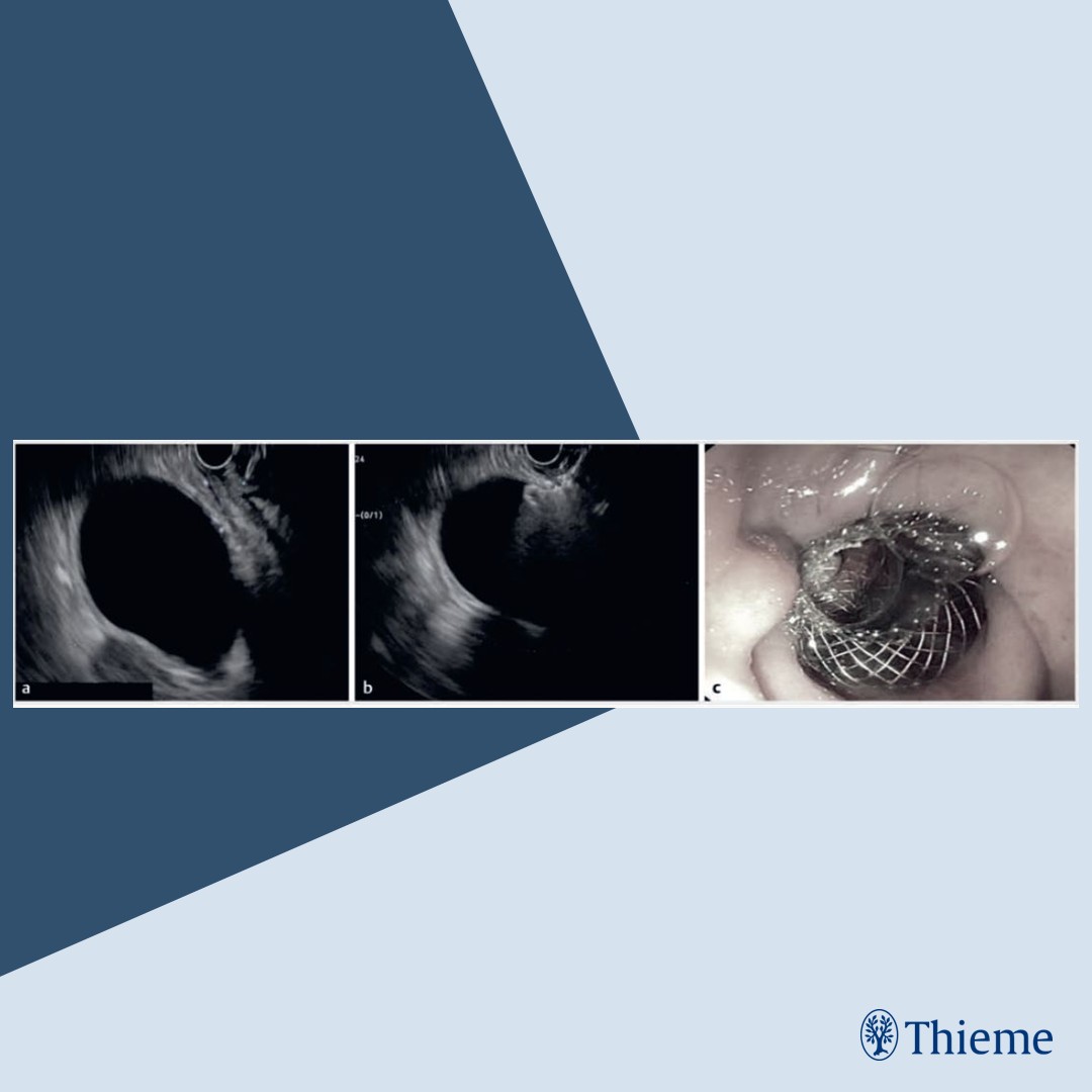 Safety and effectiveness of EUS-guided gallbladder drainage in patients with cirrhosis: an international    multicenter experience

Find the article at: doi.org/10.1055/a-2517…

Rajat Garg et al.