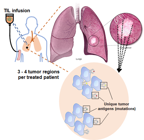 Ben Creelan, MD (@bencreelan) on Twitter photo First report on TIL therapy resistance in lung cancer! đź“°
👉nature.com/articles/s4301…
We show subclonal neoantigens are lost on progression; & antigen-specific TIL decay in non-responders.
Proud of our team, and thanks to <a href="/SU2C/">Stand Up To Cancer</a> for funding! <a href="/NatureCancer/">Nature Cancer</a> @moffittnews First report on TIL therapy resistance in lung cancer! đź“°
👉nature.com/articles/s4301…
We show subclonal neoantigens are lost on progression; & antigen-specific TIL decay in non-responders.
Proud of our team, and thanks to <a href="/SU2C/">Stand Up To Cancer</a> for funding! <a href="/NatureCancer/">Nature Cancer</a> @moffittnews