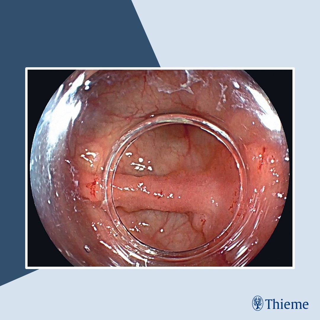 #EVideo: Endoscopic perforation after cap-suction pseudopolyp formation for underwater en bloc resection of a big cecal lesion

Find the full text and video here: doi.org/10.1055/a-2515…

Harold Benites-Goñi et al.