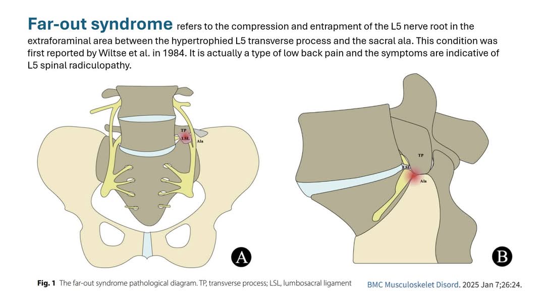 Rare, but important
Far-out Syndrome
