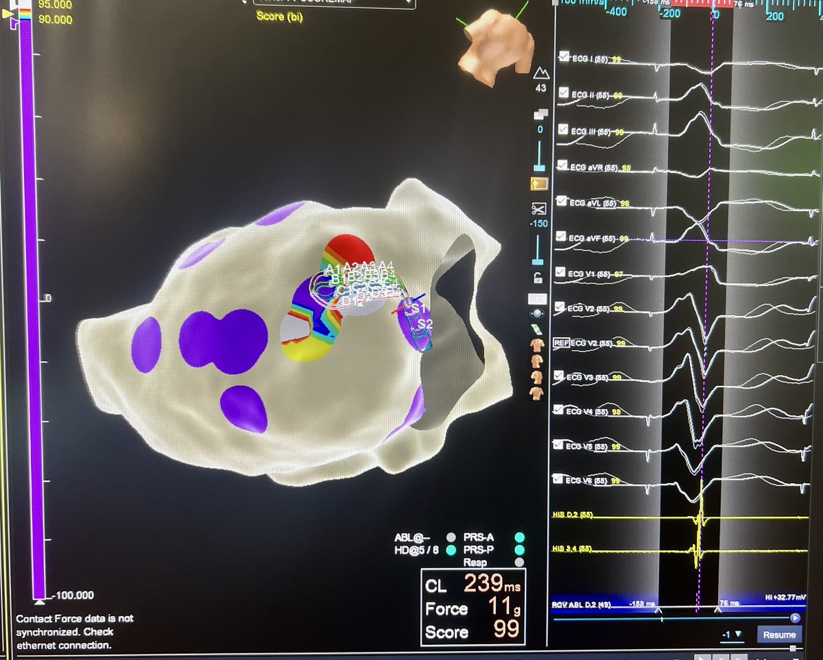 Ivo Roca, FEHRA, FESC (@ivroca) on Twitter photo Redo case: ICM+VT storm. Functional #S3 map (HDGridX). DZs correlate with CMR <a href="/ADAS3D/">ADAS3D Medical</a>. LPs in S1, blocked in S2 visible again in S3. Critical area for VT: 99% pacemap+long S-QRS. Well done <a href="/t_rosseel/">Thomas Rosseel</a> ! <a href="/hospitalclinic/">Hospital ClĂnic</a> <a href="/tolosanaviu/">Jose Maria tolosana</a> <a href="/EduGuasch/">Eduard Guasch</a> <a href="/aportasanchez/">Andreu Porta Sánchez</a> Redo case: ICM+VT storm. Functional #S3 map (HDGridX). DZs correlate with CMR <a href="/ADAS3D/">ADAS3D Medical</a>. LPs in S1, blocked in S2 visible again in S3. Critical area for VT: 99% pacemap+long S-QRS. Well done <a href="/t_rosseel/">Thomas Rosseel</a> ! <a href="/hospitalclinic/">Hospital ClĂnic</a> <a href="/tolosanaviu/">Jose Maria tolosana</a> <a href="/EduGuasch/">Eduard Guasch</a> <a href="/aportasanchez/">Andreu Porta Sánchez</a>