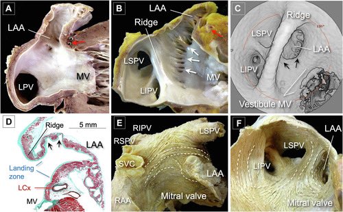 Dr. José Ángel Cabrera (@jacabreracardio) on Twitter photo May 7: the FIRST weekly issue of #JACCCaseReports <a href="/JACCJournals/">JACC Journals</a>
<a href="/GilbertTangMD/">Dr. Gilbert Tang</a>
Left Atrial Appendage Closure: Reaching More Patients Every Day
jacc.org/doi/10.1016/j.…
Percutaneous left atrial appendage (LAA) 👉an effective and safe alternative for AF patients May 7: the FIRST weekly issue of #JACCCaseReports <a href="/JACCJournals/">JACC Journals</a>
<a href="/GilbertTangMD/">Dr. Gilbert Tang</a>
Left Atrial Appendage Closure: Reaching More Patients Every Day
jacc.org/doi/10.1016/j.…
Percutaneous left atrial appendage (LAA) 👉an effective and safe alternative for AF patients