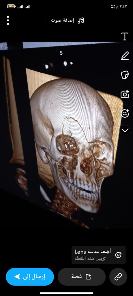 lailama61451664's tweet image. Yesterday was the anniversary of my father's death, and today my mother's skull was fractured. If my father hadn't been there, he would have controlled the situation and treated my mother, but I can't afford her treatment. I can only cook on her behalf.
chuffed.org/project/gaza-b…