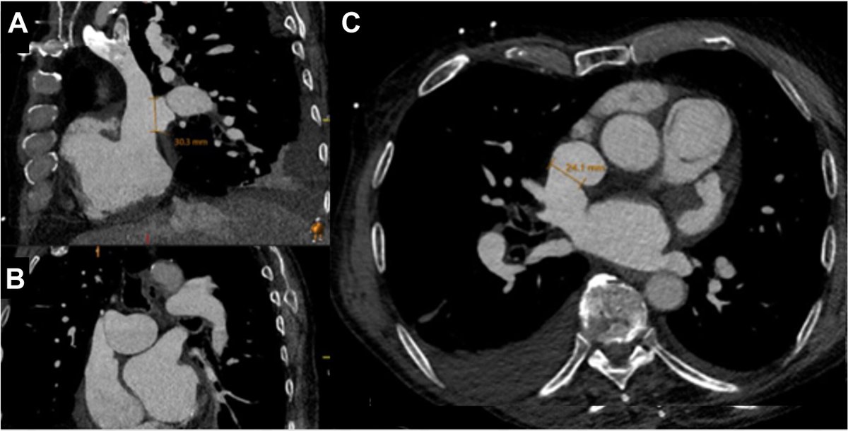Penn Cardiology (@penncardiology) on Twitter photo An 83 y/o with #SVASD & #PAPVR had no BECS option. <a href="/PennMedicine/">Penn Medicine</a> physicians modified a Harmony TPV for transcatheter repair. Full closure, restored flow at 1 month.
Check out the full case 👉 spr.ly/60102oEKK
#AllisonTsaoMD
#MatthewGillespieMD
@stephcolelloMD An 83 y/o with #SVASD & #PAPVR had no BECS option. <a href="/PennMedicine/">Penn Medicine</a> physicians modified a Harmony TPV for transcatheter repair. Full closure, restored flow at 1 month.
Check out the full case 👉 spr.ly/60102oEKK
#AllisonTsaoMD
#MatthewGillespieMD
@stephcolelloMD