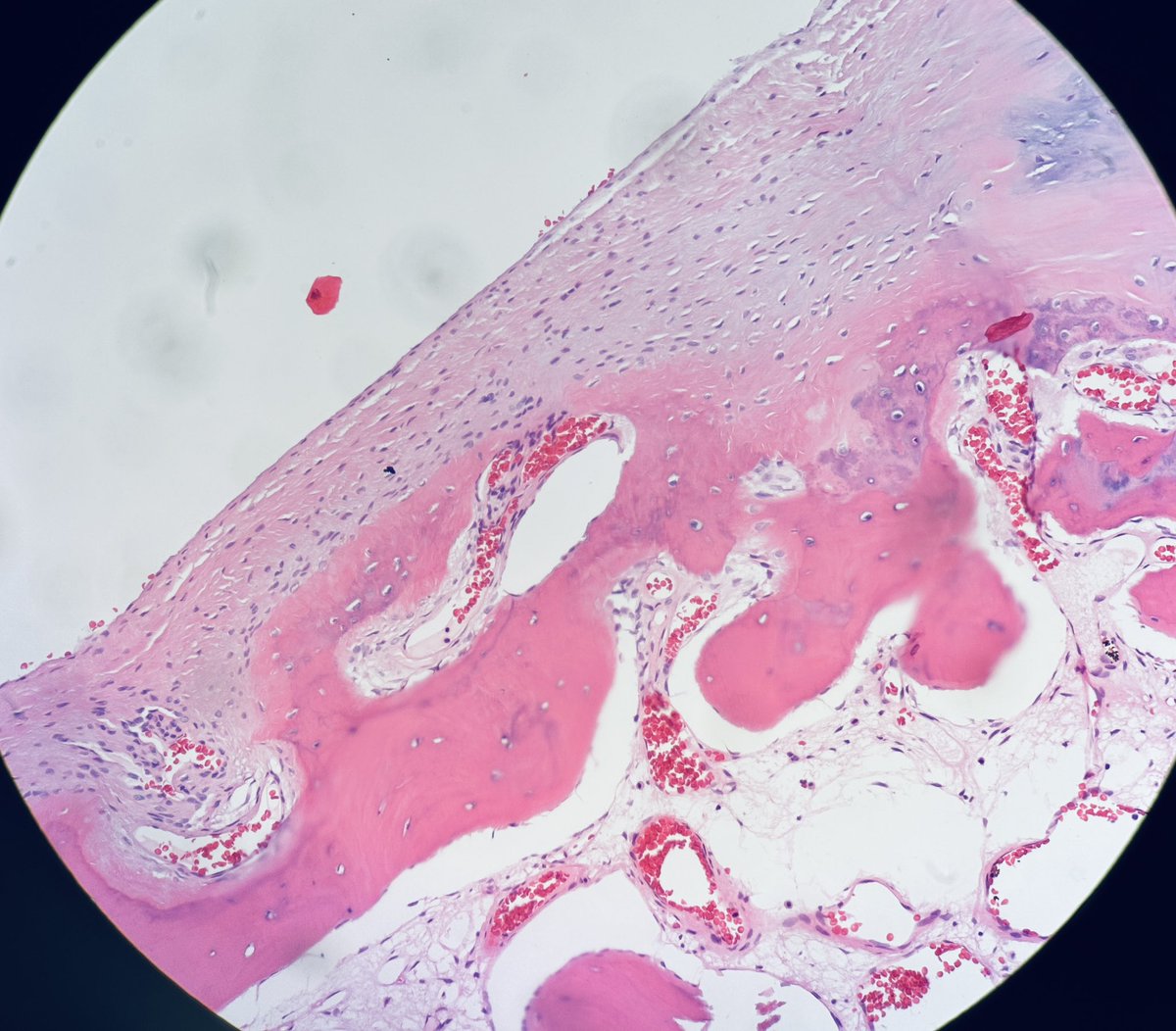 Henry YANG (@henryy_md) on Twitter photo “Nora lesion”- BPOP ( bizarre paraosteal osteochondromatous proliferation). What a bizarre name, like Nora better😝
#pathology #Pathx #PathTwitter #BSTpath
<a href="/kis_lorand/">Lorand Kis</a> you agree with me?😂 “Nora lesion”- BPOP ( bizarre paraosteal osteochondromatous proliferation). What a bizarre name, like Nora better😝
#pathology #Pathx #PathTwitter #BSTpath
<a href="/kis_lorand/">Lorand Kis</a> you agree with me?😂