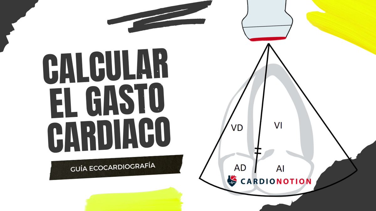 🫀Calcular el Gasto Cardiaco con Ecocardiografía es más fácil de lo que parece. ¿Quieres saber cómo?

📏Apréndelo en este hilo 🧵 👇🏼