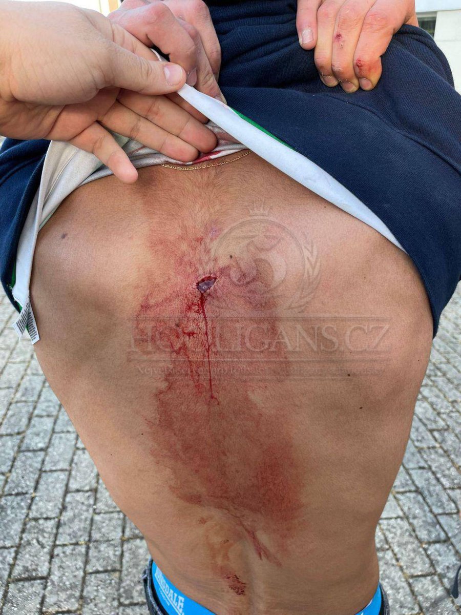 08.05.2025🇵🇹Info Sporting: Benfica attacked 2 Sporting kids and stabbed one of them. Sporting is the only Portuguese club to fight in the forest. Once again a cowardly attack of the NN without values, click for more here: hooligans.cz/2025/05/08/ben…