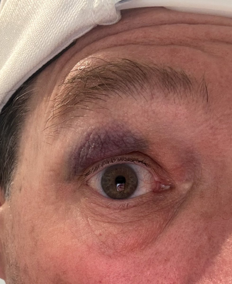 Gregg_Jefferies's tweet image. Nothing like getting hit in the eye with a tennis ball throwing to your kids. Did I stop throwing… heck no 😂