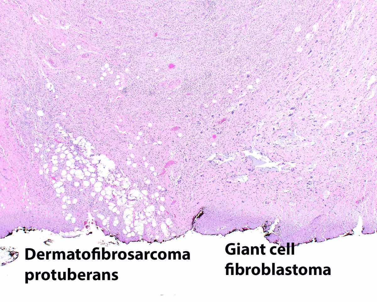 LizMontgomeryMD's tweet image. This is an example of a dermatofibrosarcoma protuberans (DFSP) arising in association with a giant cell fibroblastoma, the latter considered a forme fruste DFSP. #UMiamiPath @ModernPathology @science_press