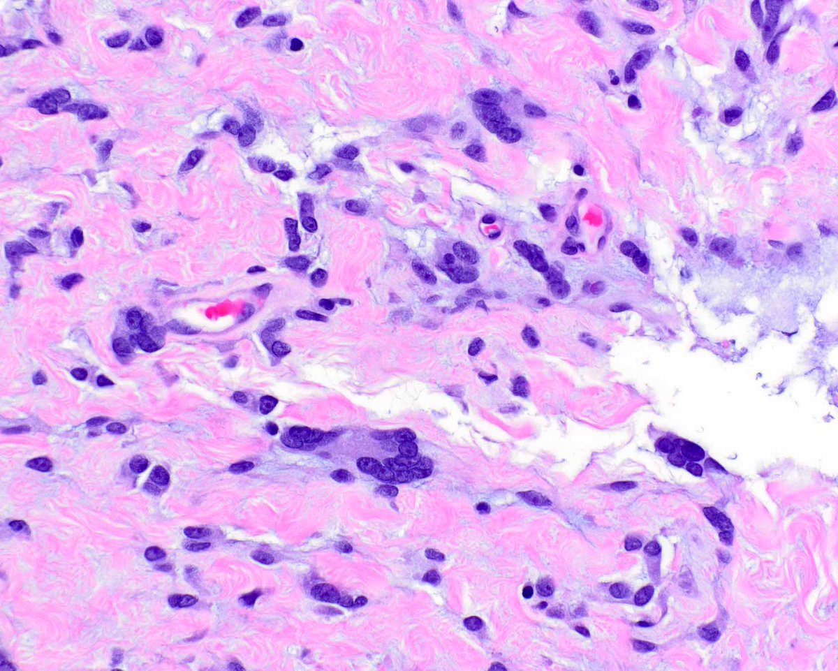 LizMontgomeryMD's tweet image. This is an example of a dermatofibrosarcoma protuberans (DFSP) arising in association with a giant cell fibroblastoma, the latter considered a forme fruste DFSP. #UMiamiPath @ModernPathology @science_press