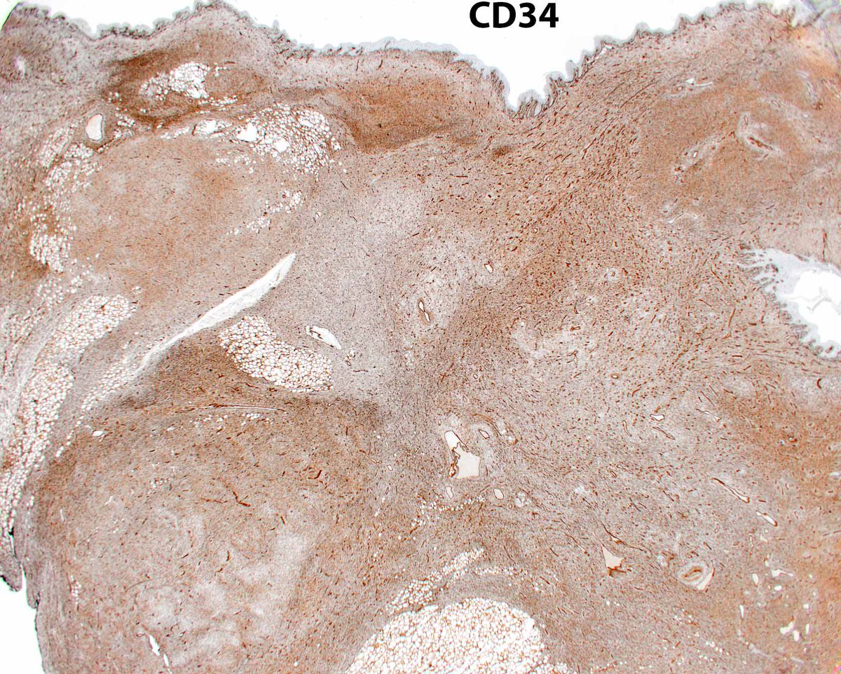Elizabeth Montgomery, MD (@lizmontgomerymd) on Twitter photo This is an example of a dermatofibrosarcoma protuberans (DFSP) arising in association with a giant cell fibroblastoma, the latter considered a forme fruste DFSP. #UMiamiPath <a href="/ModernPathology/">Modern Pathology</a> <a href="/science_press/">Innovative Science Press</a> This is an example of a dermatofibrosarcoma protuberans (DFSP) arising in association with a giant cell fibroblastoma, the latter considered a forme fruste DFSP. #UMiamiPath <a href="/ModernPathology/">Modern Pathology</a> <a href="/science_press/">Innovative Science Press</a>