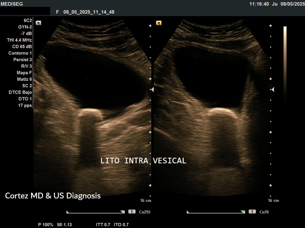 drchalocortez's tweet photo. #ayudandoadiagnosgicar Litiasis intra vesical y coledocolitiasis. https://t.co/gtLJYsQiFm