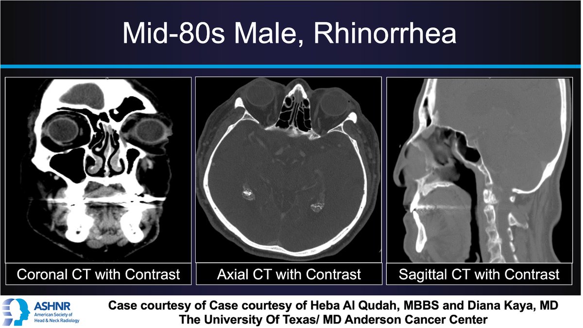 ASHNR (@ashnrsociety) on Twitter photo #ASHNRCOTW #296: Rhinorrhea. Thx
<a href="/Heba_Al_Qudah/">Heba Al Qudah</a> + <a href="/DianaKaya4/">Diana Kaya, MD</a> 4 case! #ASHNR25
Answer w/ appropriate GIF only -- stay professional & don't spoil it!
<a href="/callyrobs/">Caroline Robson, MBChB</a> <a href="/DShatzkes/">Deborah Shatzkes</a> <a href="/CDP_Rad/">C Douglas Phillips 🇺🇸</a> <a href="/rhwiggins/">Richard Wiggins</a>
<a href="/nakoontz/">Nicholas Koontz</a> <a href="/KRileyMD/">Kalen Riley</a> <a href="/CMGlastonbury/">Christine M Glastonbury, MD</a> <a href="/tabby_kennedy/">Tabby A. Kennedy, MD</a> <a href="/PhilipRChapman1/">Philip R. Chapman, MD</a> <a href="/cmtomblinson/">Courtney Tomblinson, MD</a> #ASHNRCOTW #296: Rhinorrhea. Thx
<a href="/Heba_Al_Qudah/">Heba Al Qudah</a> + <a href="/DianaKaya4/">Diana Kaya, MD</a> 4 case! #ASHNR25
Answer w/ appropriate GIF only -- stay professional & don't spoil it!
<a href="/callyrobs/">Caroline Robson, MBChB</a> <a href="/DShatzkes/">Deborah Shatzkes</a> <a href="/CDP_Rad/">C Douglas Phillips 🇺🇸</a> <a href="/rhwiggins/">Richard Wiggins</a>
<a href="/nakoontz/">Nicholas Koontz</a> <a href="/KRileyMD/">Kalen Riley</a> <a href="/CMGlastonbury/">Christine M Glastonbury, MD</a> <a href="/tabby_kennedy/">Tabby A. Kennedy, MD</a> <a href="/PhilipRChapman1/">Philip R. Chapman, MD</a> <a href="/cmtomblinson/">Courtney Tomblinson, MD</a>