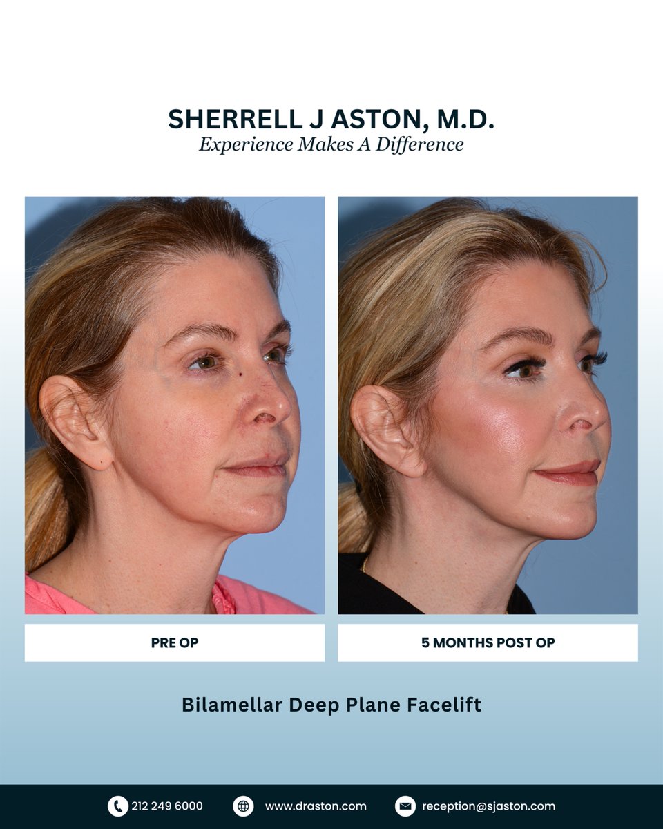 53 years young beautiful lady 5 months following Bilamellar Deep Plane Facelift and autologous fat grafting to enhance facial symmetry. Fabulous upper and midface youthful shape and elimination of all lower face laxity and heaviness. Now she has a #collegeagefacialshape.