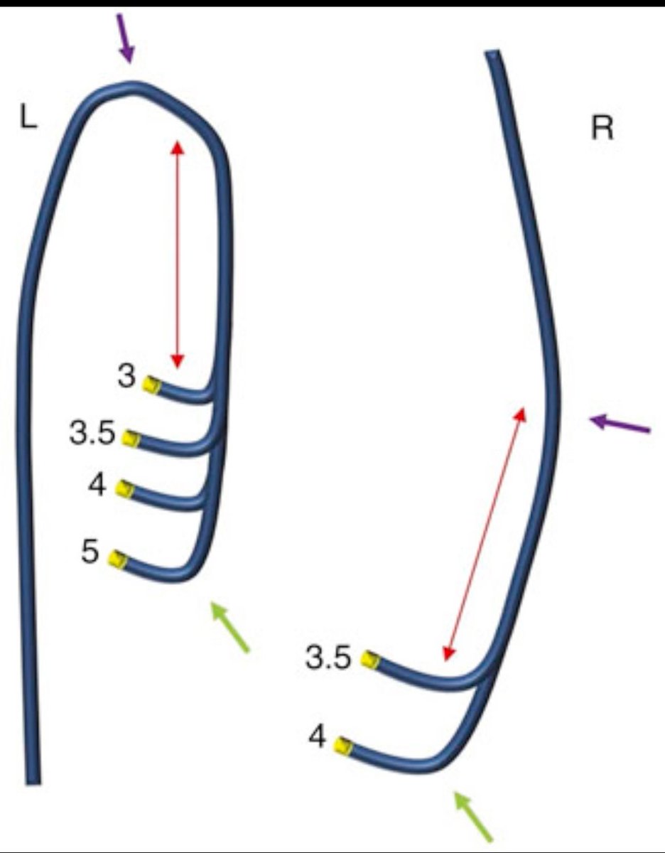 Judkins Catheters: Precision in Coronary Access
Invented by Dr. Melvin Judkins in the 1960s, these pre-shaped diagnostic catheters revolutionized coronary angiography by enabling selective cannulation of coronary arteries via a percutaneous femoral (or radial) approach.

Left (L)