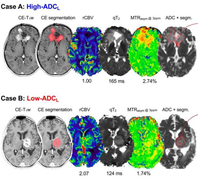 Journal of Neuro-Oncology (@jneurooncol) on Twitter photo Sanvito et al <a href="/FraSanvito/">Francesco Sanvito</a> <a href="/RadiologyUcla/">UCLA Radiology</a> characterized post-chemoradition GBM stratified by MRI phenotypes and found distinct perfusion, metabolic, and T2 relaxation feature in tumors with profiles predictive of favorable anti-VEGF response.#JNO
Read more:link.springer.com/article/10.100… Sanvito et al <a href="/FraSanvito/">Francesco Sanvito</a> <a href="/RadiologyUcla/">UCLA Radiology</a> characterized post-chemoradition GBM stratified by MRI phenotypes and found distinct perfusion, metabolic, and T2 relaxation feature in tumors with profiles predictive of favorable anti-VEGF response.#JNO
Read more:link.springer.com/article/10.100…