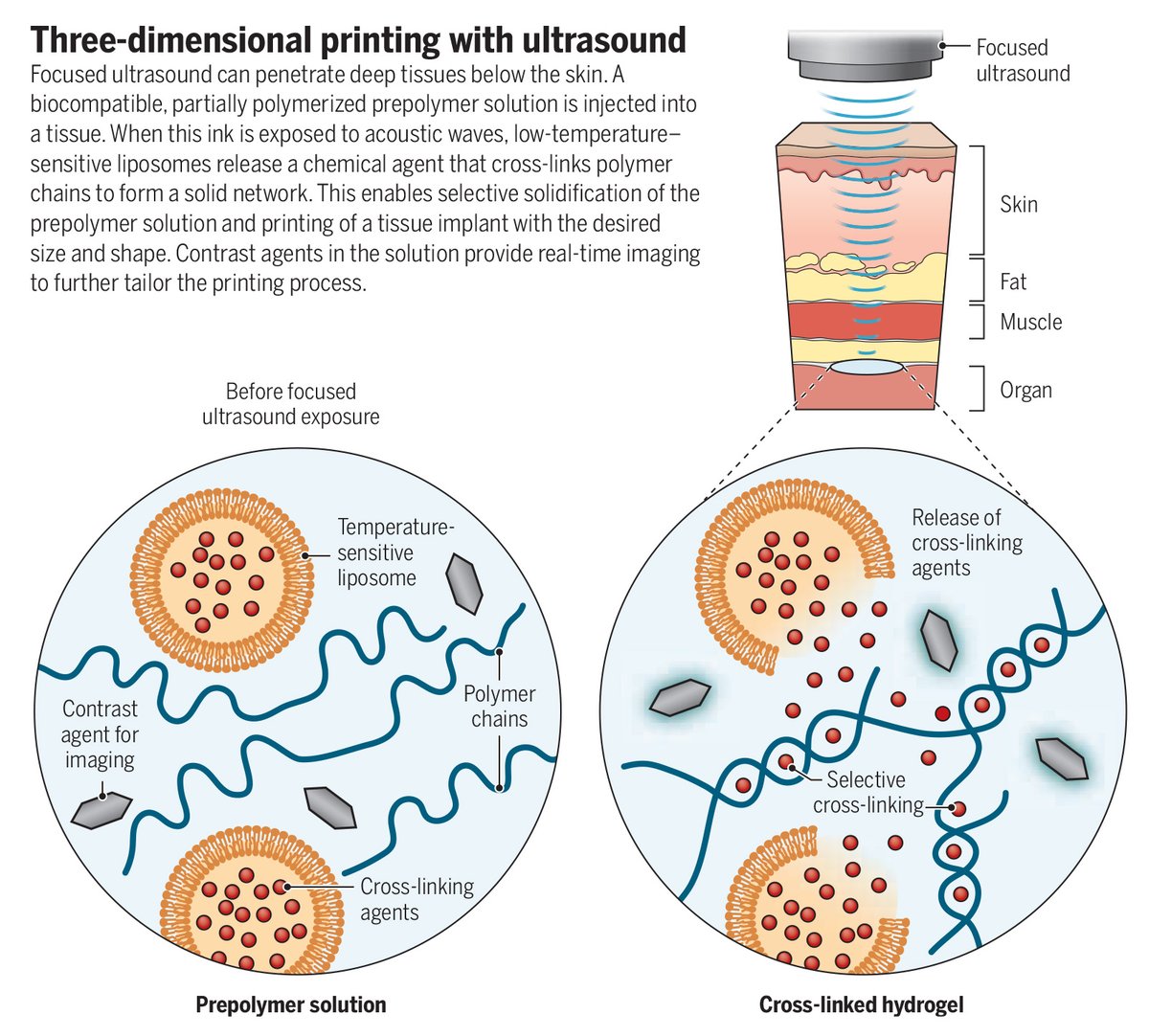 ScienceMagazine's tweet image. A new ultrasound-guided #3Dprinting technique could make it possible to fabricate medical implants in vivo and deliver tailored therapies to tissues deep inside the body—all without invasive surgery, researchers report in Science.
📄: scim.ag/3GWmu2Y…
