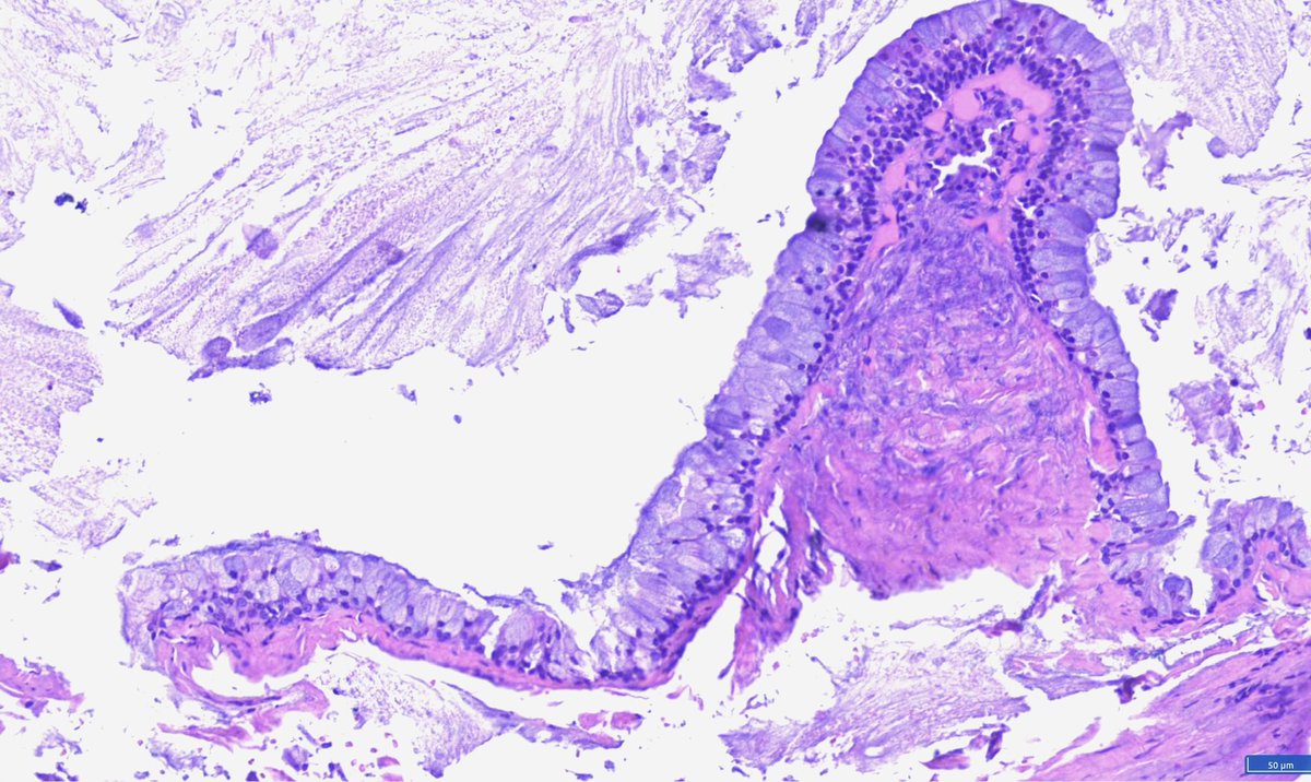 Hashimoto__0's tweet image. Guess which one is mucoepidermoid ca?😁