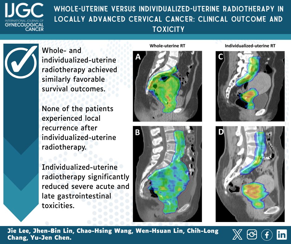 IJGC (@ijgconline) on Twitter photo Whole-uterine versus individualized-uterine #radiotherapy β’οΈ in locally advanced #cervicalcancer: clinical outcome and toxicity
β© bit.ly/4m8slCy
<a href="/pedroramirezMD/">Pedro T Ramirez</a> <a href="/HsuMd/">Arthur_HC_Hsu</a> <a href="/JayrajAarthi/">Aarthi S Jayraj</a> <a href="/AndreFernandes2/">Andreina Fernandes</a> <a href="/IGCSociety/">IGCS</a> <a href="/ESGO_society/">ESGO</a> <a href="/ENYGO_official/">European Network of Young Gynae Oncologists</a> <a href="/OncoAlert/">OncoAlert</a> <a href="/IJGCfellows/">IJGC Fellows</a> Whole-uterine versus individualized-uterine #radiotherapy β’οΈ in locally advanced #cervicalcancer: clinical outcome and toxicity
β© bit.ly/4m8slCy
<a href="/pedroramirezMD/">Pedro T Ramirez</a> <a href="/HsuMd/">Arthur_HC_Hsu</a> <a href="/JayrajAarthi/">Aarthi S Jayraj</a> <a href="/AndreFernandes2/">Andreina Fernandes</a> <a href="/IGCSociety/">IGCS</a> <a href="/ESGO_society/">ESGO</a> <a href="/ENYGO_official/">European Network of Young Gynae Oncologists</a> <a href="/OncoAlert/">OncoAlert</a> <a href="/IJGCfellows/">IJGC Fellows</a>