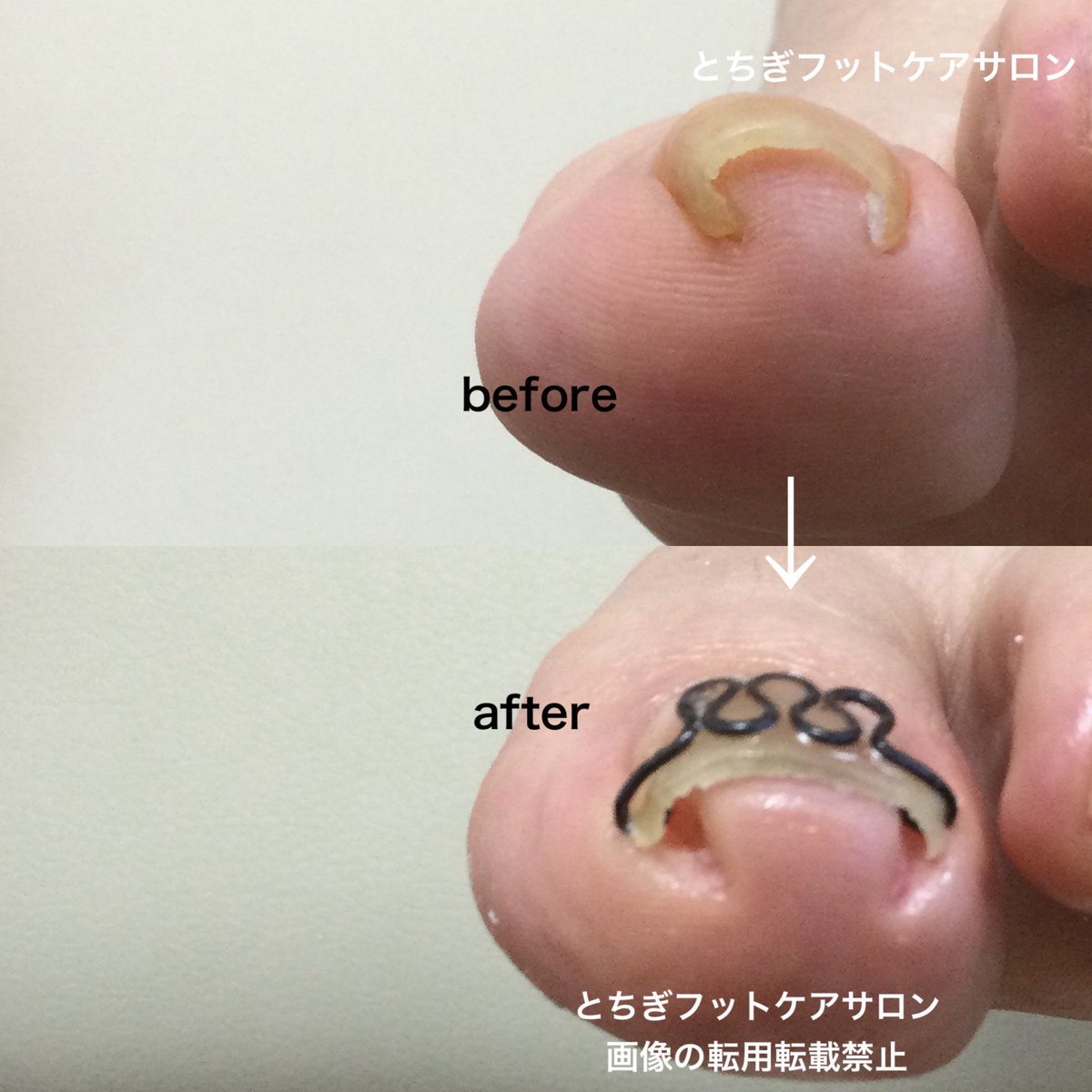 とちぎフットケアサロン-茂木有紀 (@fuss04tochigi) / Posts / X