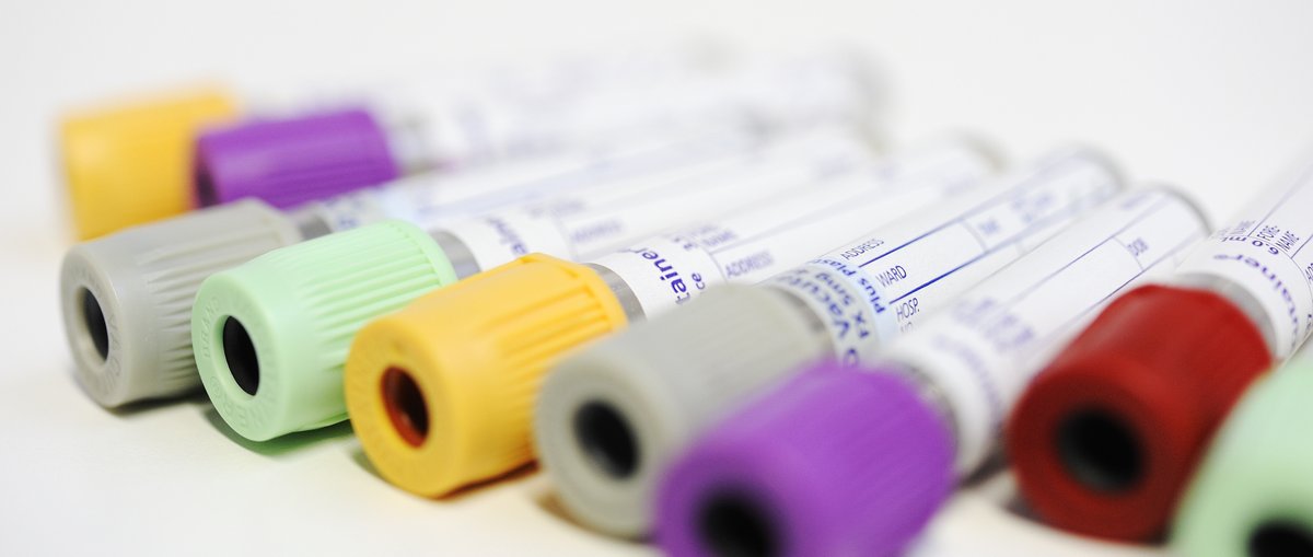 A blood test for many different types of cancer could thwart progression while the disease is still at an early stage in up to half of cases, suggests research published in <a href="/BMJ_Open/">BMJ_Open</a>. bit.ly/43lImxA